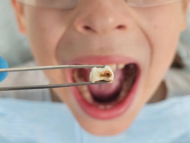 Best Emergency Tooth Extraction in West Union, IA